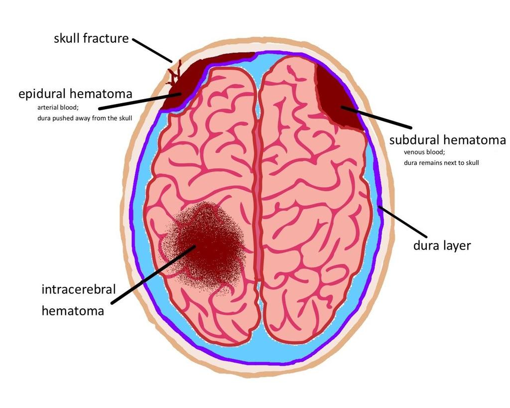 Intracranial Hemorrhage Epidural hemorrhage Subdural