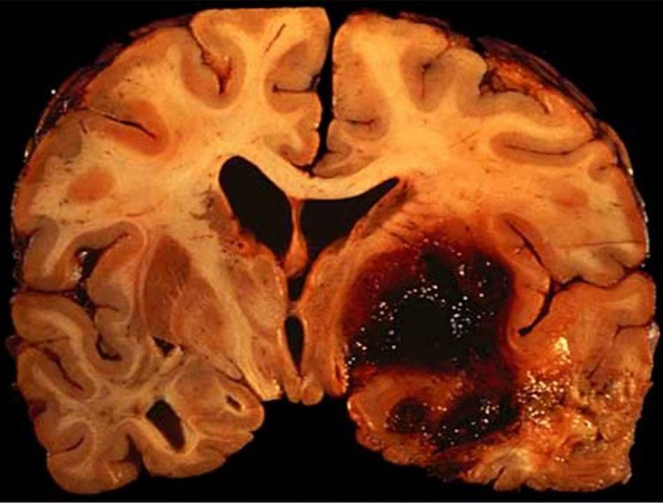 Cerebral hemorrhage Caused by bleeding within the