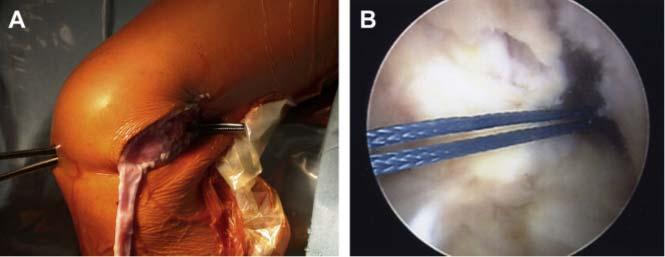 Physeal sparing reconstruction of the anterior cruciate ligament in