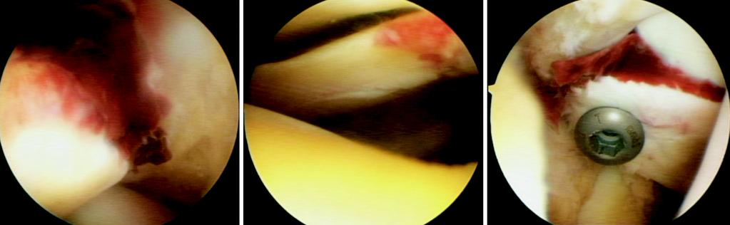 rthroscopic findings of an avulsion fracture of the anterior cruciate ligament and a hematoma (), an incomplete tear of the lateral meniscal posterior horn (), and an accurate fixation with a