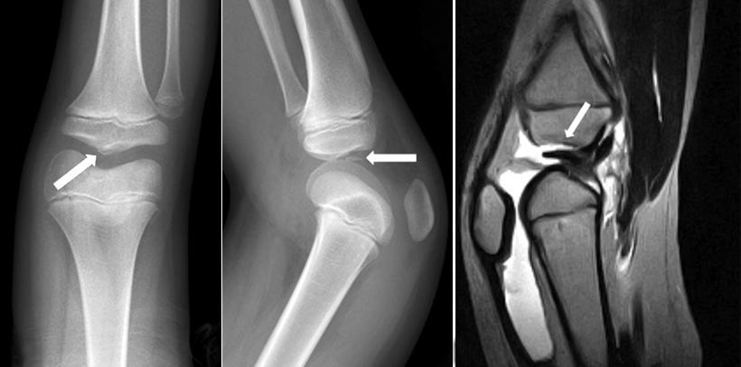 The incomplete tear of the posterior horn of the lateral meniscus was conservatively treated.