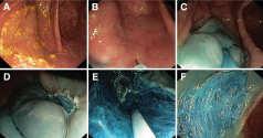 5-23%) Risk Factors Large size: 17% for > 10 mm Serrated polyps: 31% Less than 20 polypectomies/year