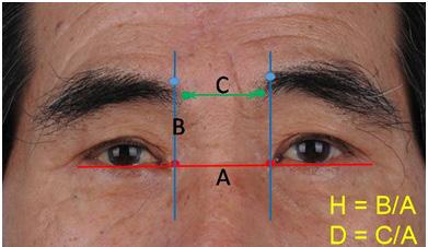 Choi JS et al. Evaluation of the donor site after MFF In this study, the authors examined the donor sites on the forehead among patients who underwent reconstruction using a median forehead flap.