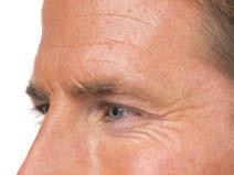 eyebrows, swelling of your eyelids and dry eyes.