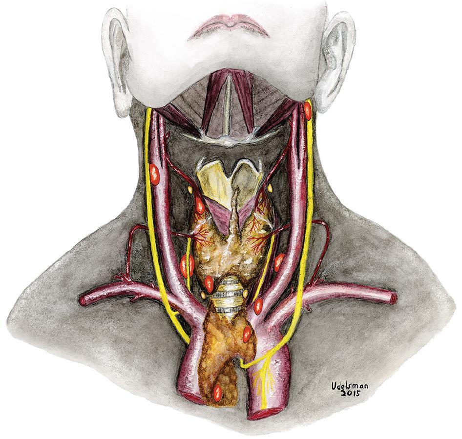 Parathyroidectomy Minimally Invasive Parathyroidectomy 85% single gland Bilateral Exploration 15% multi-gland