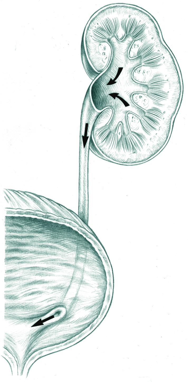 Vesicoureteral reflux is a condition in which urine travels backward from the bladder toward the kidney and may affect one or both ureters. Figure 1 shows the urinary tract.