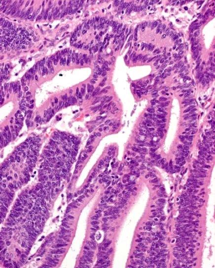 Gastric type cervical adenocarcinoma Histologic subtype (n=47) RECIST (ver. 1.