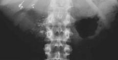 Pancreatitis x-ray and fecal fat have a