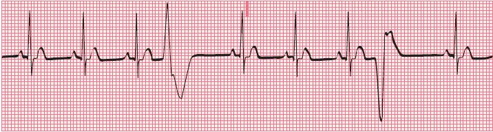 9.2 Premature Ventricular Complex (PVC) Caused by an ectopic impulse that occurs early in the cycle and originates from the ventricles Caused
