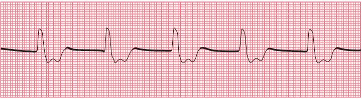 9.5 Accelerated Idioventricular Rhythm Impulse created by the ventricular pacemaker The heart rate is faster than an