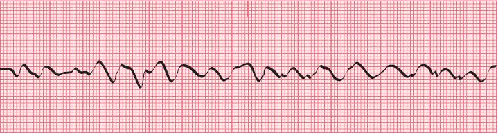 9.7 Ventricular Fibrillation (V fib) Chaotic asynchronous electrical activity within ventricular tissue Ventricle walls are quivering,