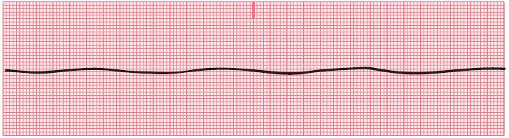9.8 Asystole Often called straight line or flat line No electrical activity