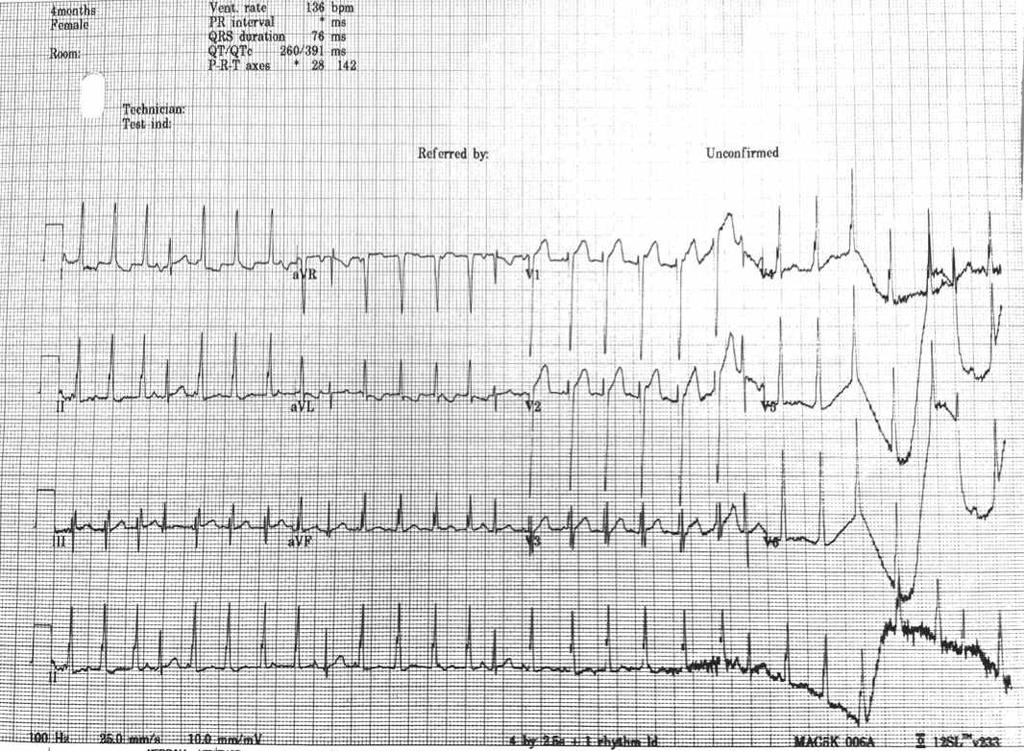 April 16 2013 EKG Week 13 4 months old with ALTE 1. What is the diagnosis? 1. Left ventricular hypertrophy 2.