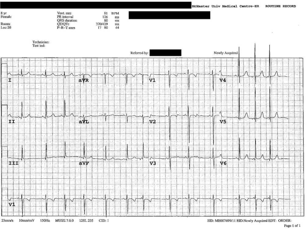 EKG of the week 1-5 Oct 2012 Survey EKG of the week 1-5 Oct 2012 EKG 3 12-10-01 3:41 PM 8 year old boy was brought to ER for chest pain. He has mild developmental delay and ADHD and is on Concerta.