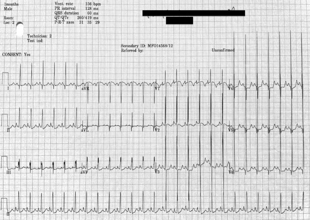EKG of the week Oct 29th - Nov 2nd 2012 Survey EKG of the week Oct 29th - Nov 2nd 2012 EKG 6 12-10-30 8:11 AM 1. Before you begin the test, please identify yourself with one of the following groups 1.
