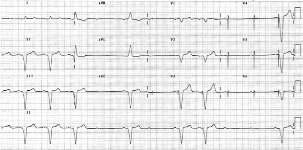 EKG #5 71 y/o woman with a dual-chamber pacemaker implanted for CHB who presents for a urgent visit because of intermittent lightheadedness. Programming: DDDR 60-120 bpm.