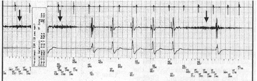 This may be difficult to diagnose, so pacemaker-dependent patients with symptoms of lightheadedness, near-syncope or syncope should be