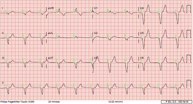 EKG #2 82 y/o man with a dual-chamber pacemaker implanted for CHB 10 years ago presents