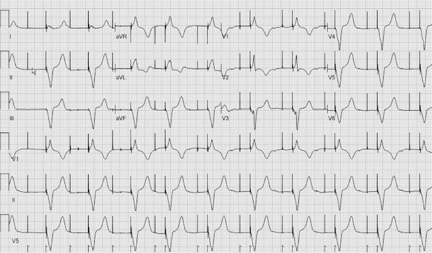EKG #3 77 y/o man with a dual-chamber pacemaker implanted for SSS presents for an annual visit. Symptoms: intermittent palpitations. Programming: DDDR 60-120 bpm.