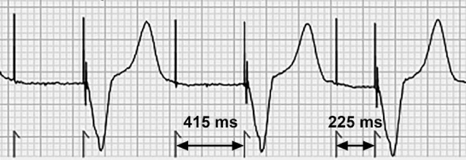 EKG #3: Explanation - This EKG demonstrates an atrial and ventricular paced rhythm with intermittent AV delay prolongation.