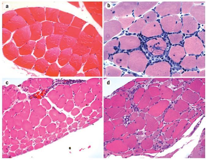 Muscle histopathology a) Normal muscle b) PM endomysial inflammation c) DM