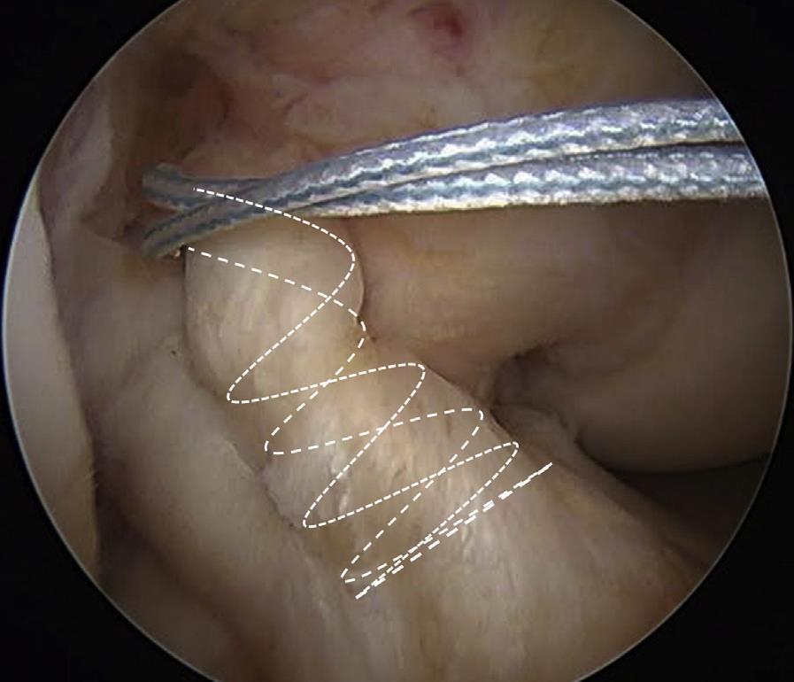 Acute Proximal Anterior Cruciate Ligament Tears: Outcomes After Arthroscopic Suture Anchor Repair