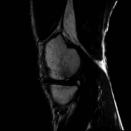 Persistence of Bone Marrow Lesion Gomespereira, V itor, Juninho 200988522 1 /8 /1 9 8 9 2 7 Y E A R M H MRI OCT 2017 Radioimagen Medica Gomespereira, Radioimagen Medica V itor, Juninho 200988522 O U