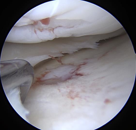 Left knee intra-articulate