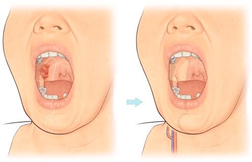 a loose tooth a persistent blocked nose, or nose bleeds a constant sore throat and earache on one side a swelling or lump in the face, mouth or neck pain or numbness in the face or upper jaw Some of