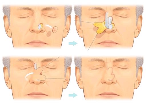 In this case a skin cancer has been removed from the nose leaving a defect that cannot simply be stitched up. A local flap, called a bilobed flap is used to close the defect.