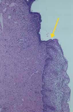 Cervical squamo-columnar junction