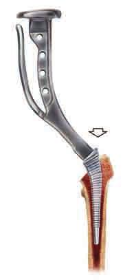 Posterior Approach Figure 4A Posterolateral/Anterolateral Approach Figure 4B Femoral canal preparation The Corail broach is available with several broach handle options depending on the surgical
