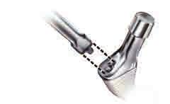 Figure 8B If the non-retaining inserter is chosen, introduce stem by hand into femoral canal (Figure 8A).