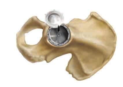 Acetabular Insert Implantation Following the final trial reduction,