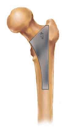 Center the resection guide along the neutral axis of the femur and mark the resection line.