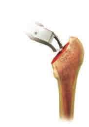 Using the cup impactor, place a trial cup sizer into the reamed acetabulum and assess its position and cortical bone