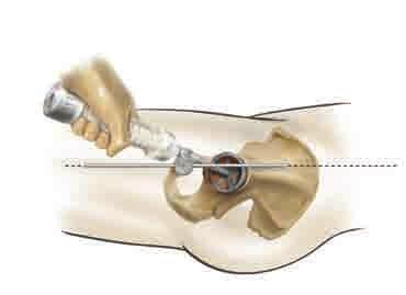 The trial cup angle of orientation should match that recorded during preoperative templating, which is normally 45