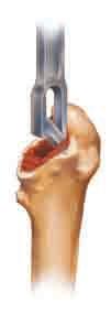 Metaphyseal preparation (optional) The version osteotome can be used to remove a wedge of cancellous bone, creating a