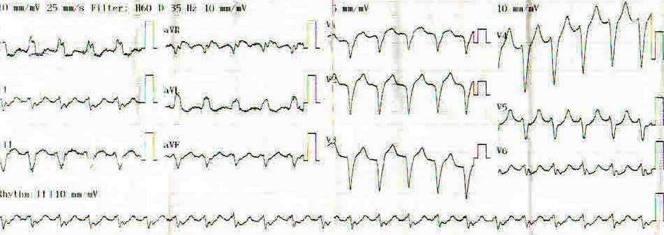 Fig 5: Different VT morphology of RV origin of the same patient The patient sent back to intensive care unit.