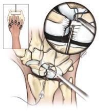 A needle is inserted under visual control through the 3-4 portal but rather than penetrating the radiocarpal joint it is inserted through the dorsal capsule and used to spear the radial and ulnar