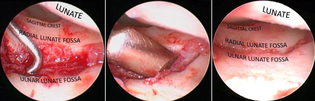 Malunion of the radius articular surface can be also approached under arthroscopic guidance.