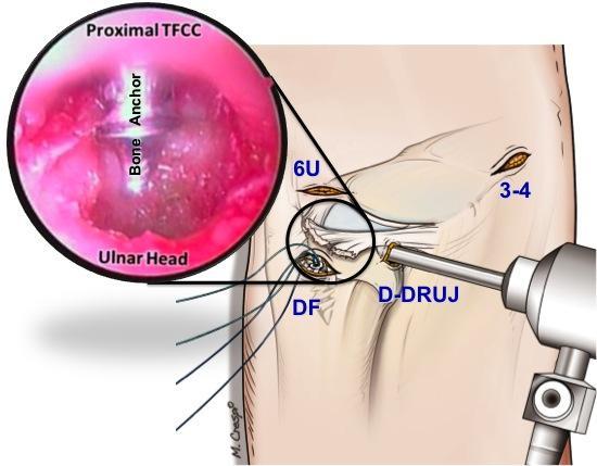 DRUJ instability and require reinsertion of the TFCC onto the ulnar head. Irreparable foveal disruption (Class 4) requires TFCC reconstruction by tendon graft.