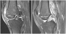 What are the causes and treatment? 4 pts The image shows an ACL tear.