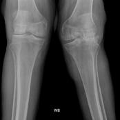 (c) What does the X-ray show? What are the causes and treatment? 4 pts This image show osteoarthritis of the knee. The cause of this is wear and tear of the cartilage.