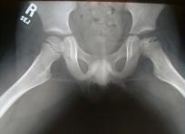 collapsed femoral head on the right. The cause is genetic and affects more boys than girls.
