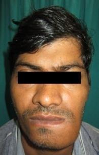 Figure 1: Extra oral view showing facial asymmetry due to the large, diffuse swelling extending from right corner of the mouth crossing midline to the left angle region.