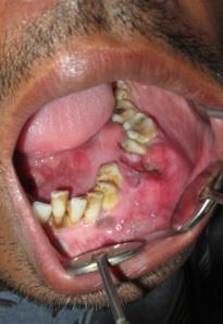 Swelling was firm to palpate & mobility was present from 36 to 45. (Figure 2) Figure 2: Intra oral view showing the the swelling from 38 to 45 region.