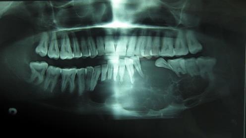 An incisional biopsy was done in the left premolar region and sections from the specimen revealed ameloblastomatous odontogenic epithelium arranged in follicles, cords and strands.