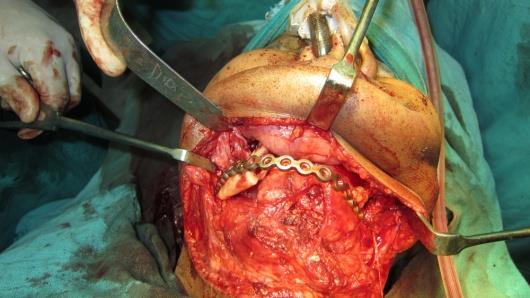 Although, mandibular reconstruction using iliac crest graft was intended taking the extent of the defect into consideration, due to the compromised nature of the soft tissue overlying the defect,