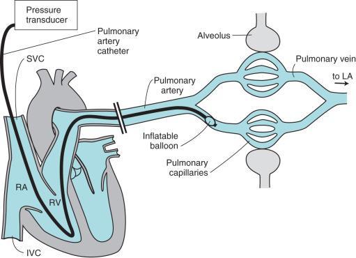 Anatomic and Physiologic Aspects of the Pulmonary Vasculature Steven E.